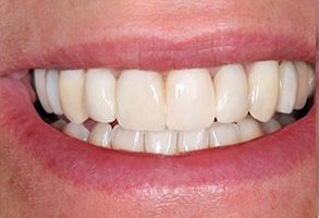 Before and After Dental Implants near Concord
