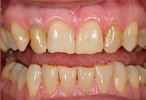 Before and After Invisalign near Concord